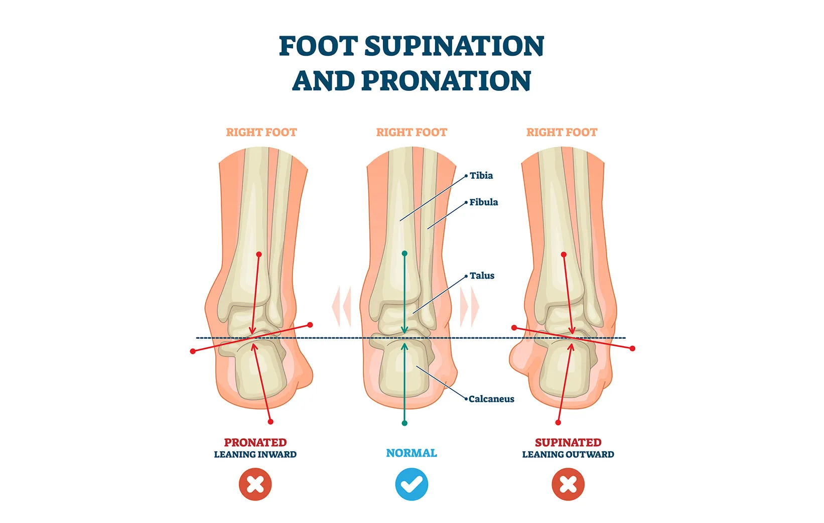 Pedag-CORRECT PLUS | over-supination insole